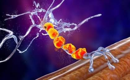 A graphic depicting degenerating motor neurons. Image: Adobe. A purple, red and yellow graphic depicting motor neurons degenerating.
